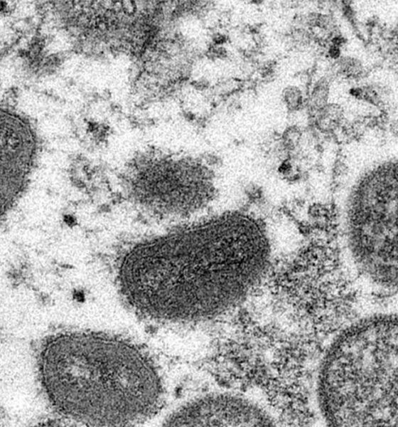 La viruela del mono es una infección rara pero peligrosa, similar al ya erradicado virus de la viruela.